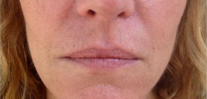 Smoker's Lines Collagen Restoration