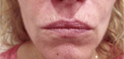 Smoker's Lines Collagen Restoration