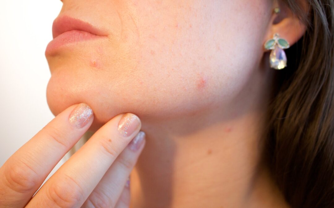 ACNE: AN INFECTION THAT BEGINS IN THE GUT
